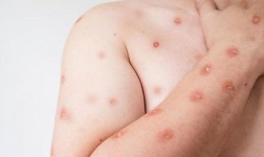 SES alerta para monitoramento de casos de Mpox em MT após avanço de variante em Rondônia